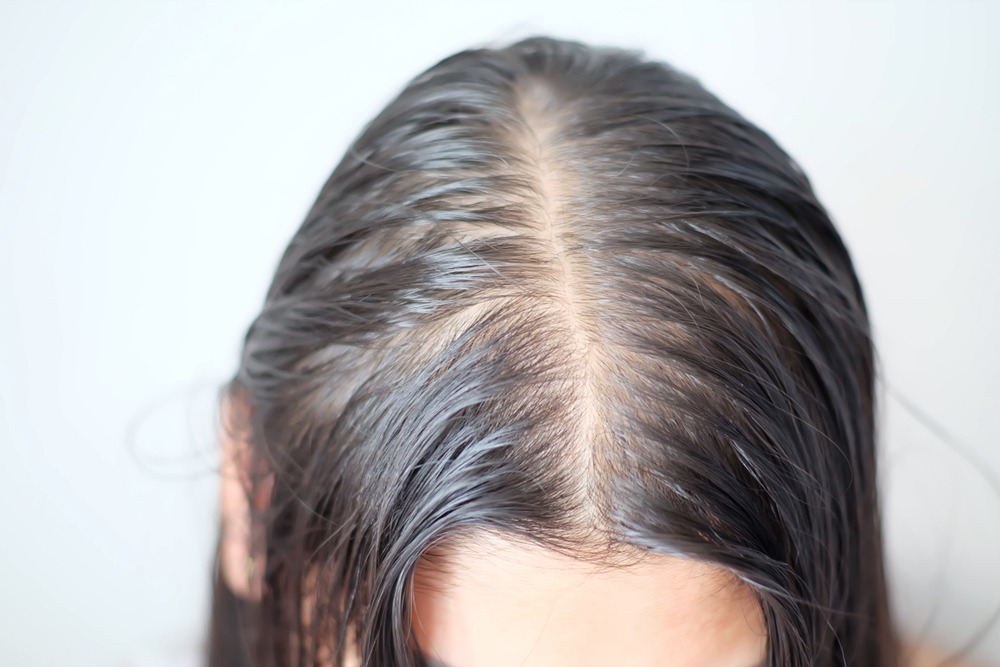 Capelli diradati di una donna visibili lungo la riga centrale